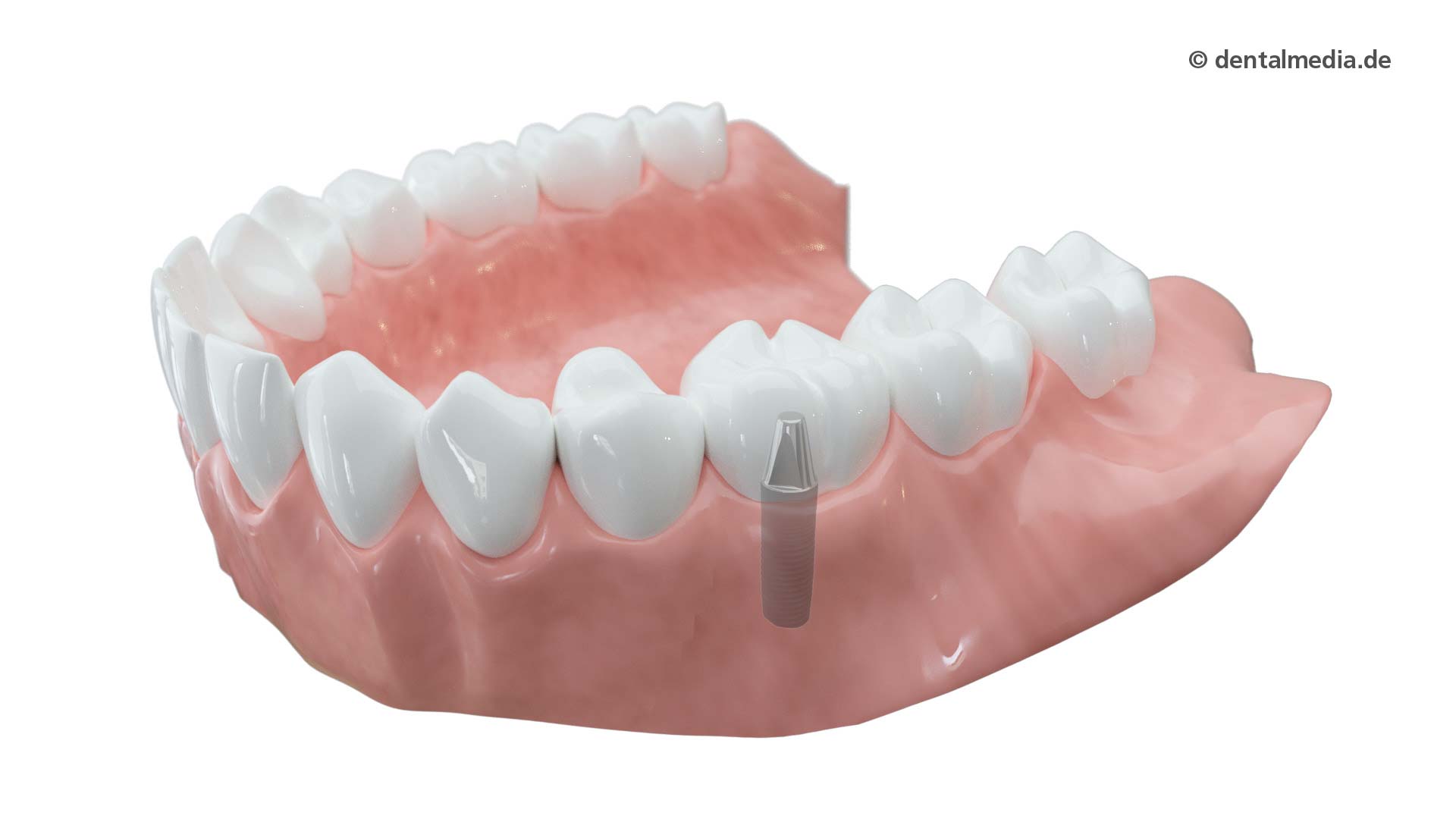 Zahnkrone aus Vollkeramik — Zahnarztpraxis Gäde in Stendal