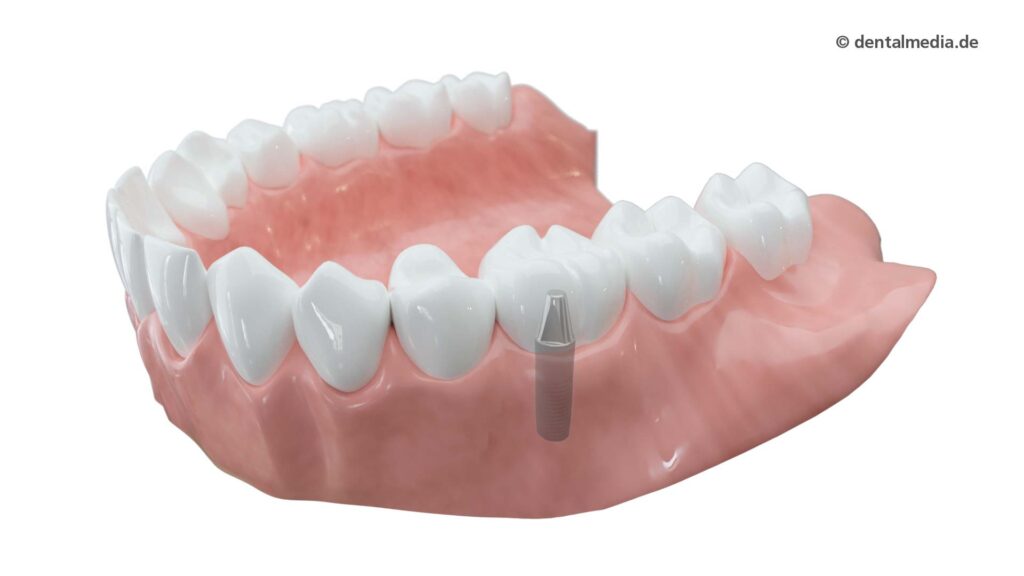 Zahnkrone — Zahnarztpraxis Gäde in Stendal