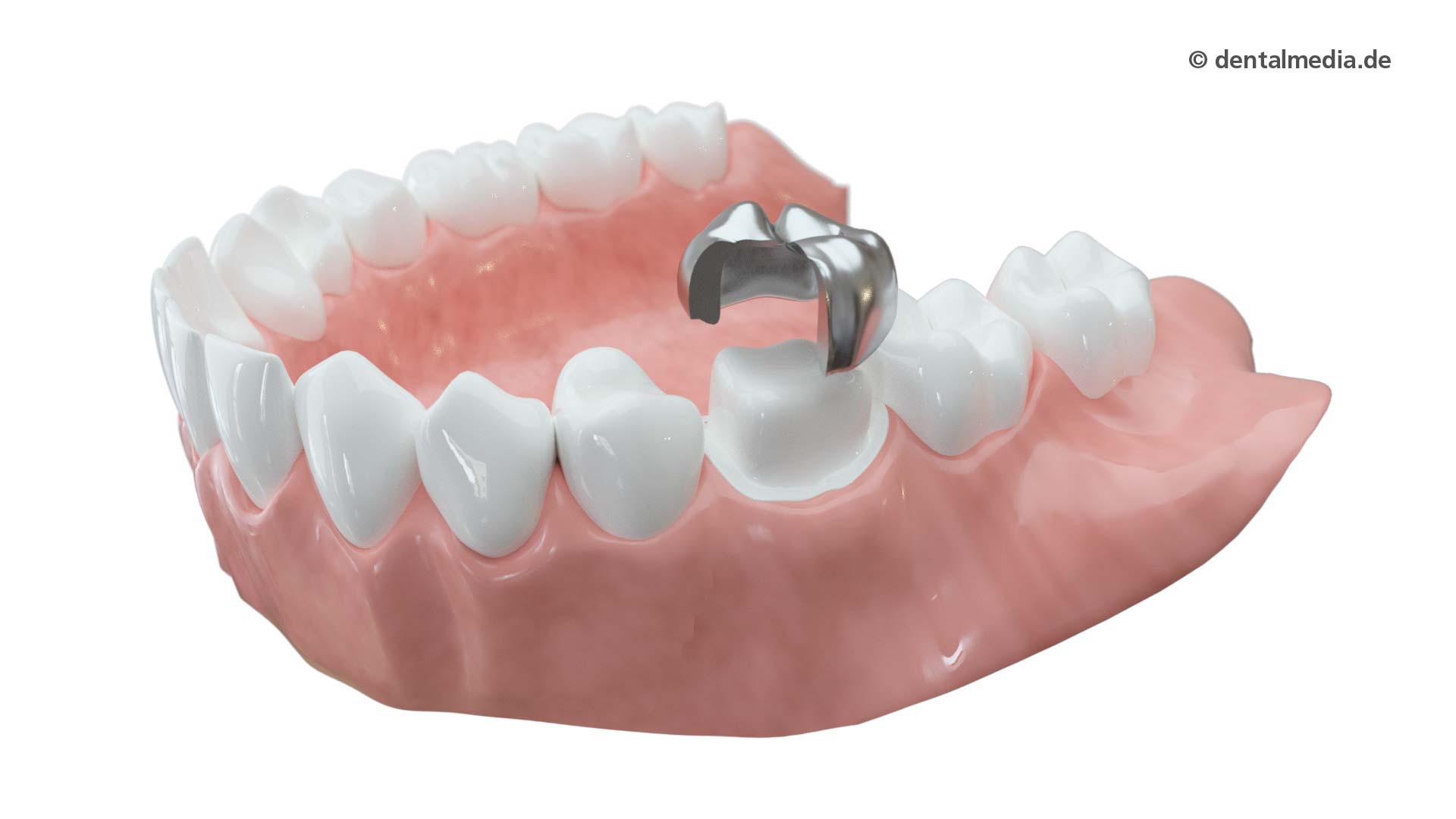 Zahnkrone aus Metall — Zahnarztpraxis Gäde in Stendal