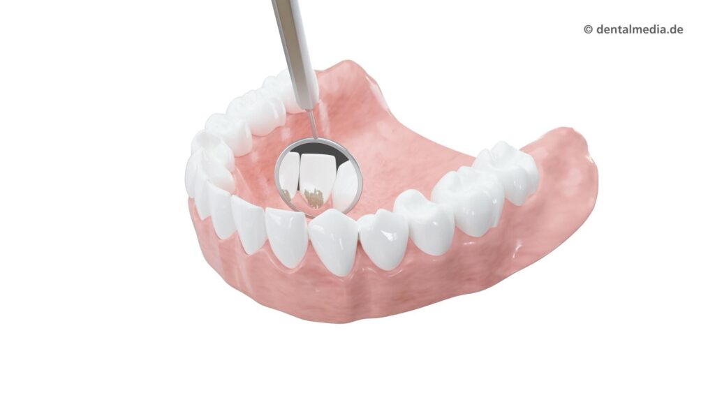 Professionelle Zahnreinigung — Zahnarztpraxis Gäde in Stendal